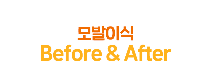 모발이식 before after