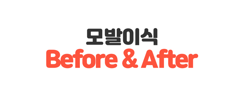 모발이식 before after